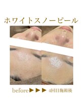 アンドエスビューティ(&S Beauty)/乳酸ピーリング