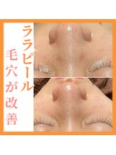 トータルビューティーサロン ヴィヴィエ(ViVier)/ララピール症例3回