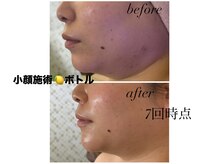 マスカレード(Masquerade)の雰囲気（人気急上昇！【脂肪分解レモンボトル】7回終了時点）