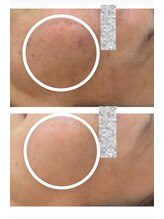 エステサロンパリス(Esthe Salon Paris)/まずはコンシーラいらずの肌へ