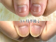 グラシナ 鳥丸店/(深爪/長さだし/フィルイン/)