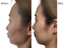 アロエベル(aloe Belle)/Before After（3回施術）