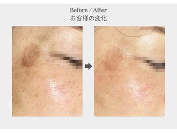 ベル 新橋(Belle)/ハーブピーリング×シミくすみ