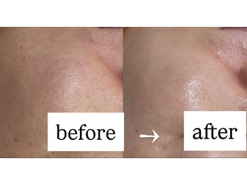 ルネ(Renee)/新毛穴洗浄esV10　(6回の変化)