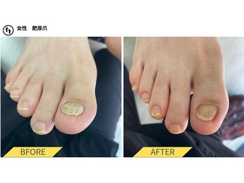 肥厚爪ケア