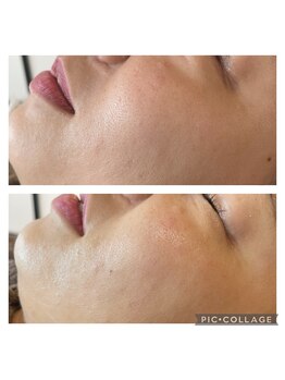 ムーラン(mulan)/ハーブピーリング