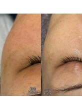 オルオル 天神大名店(Olu-.olu.)/肌質改善「しみ」「改善」