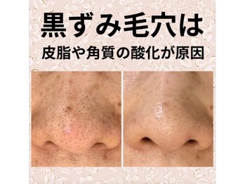 アンパス(Unpas)/毛穴洗浄の効果