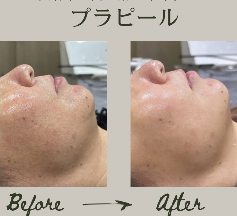 当店在庫してます！ 美容家の中で話題♡最新のピーリング！プラピール⭐️美容サロン パック・フェイスマスク