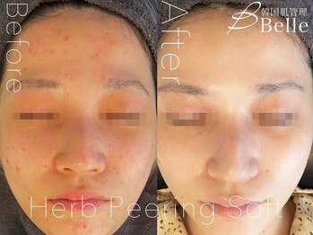 ベル 仙台(Belle)/ ハーブピーリング｜ニキビケア