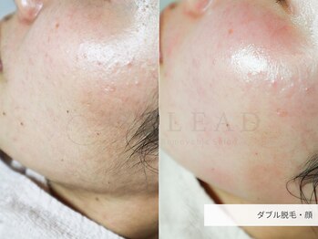 クリード(CLEAD)/フェイシャルダブル脱毛/12000円
