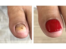 自爪ケアサロン 横浜/足爪が剥がれた/義爪