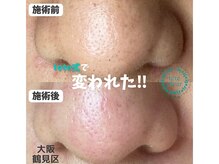 リッカロッカ(RIKKA&ROCCA)/毛穴エクストラクション