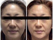 ミロク(369)/Before＆After プラズマシャワー