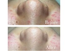 MMK/ポツポツニキビ毛穴に働きかける