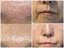 遂に西尾初！韓国肌管理スーパージェクションで肌悩み解決