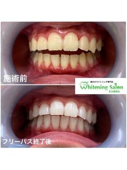 ホワイトニングサロン 名古屋駅店/【ホワイトニング施術例】