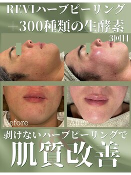 リヴィタ 仙台/メンズの皮脂角栓ニキビも◎