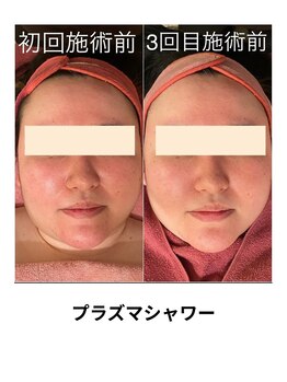 ビービー(BB)/プラズマシャワー＋ポイント