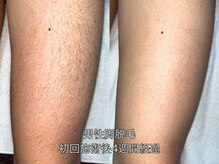 エクレ 柏店(EKURE)/メンズ脚脱毛