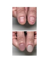 ティアラネイル 宇都宮/深爪矯正