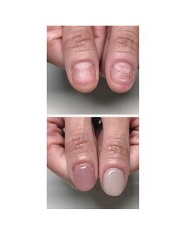 ティアラネイル 宇都宮/深爪矯正