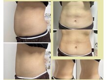 リタプレイス 琴似(LITAPLACE)/針を使わない脂肪分解ケア