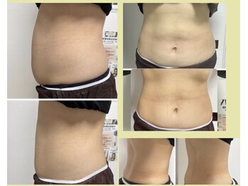 リタプレイス 琴似(LITAPLACE)/針を使わない脂肪分解ケア