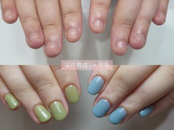 ミンスネイル(Mins Nail)/深爪矯正before&after