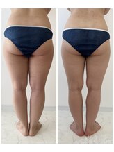 アンドモア(&more)/痩身症例