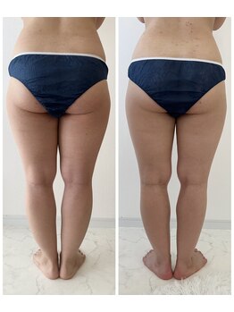 アンドモア(&more)/痩身症例