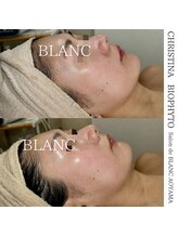 サロン ド ブラン アオヤマ(Salon de BLANC AOYAMA)/BIOPHYTO×韓国美容機器ソノケア