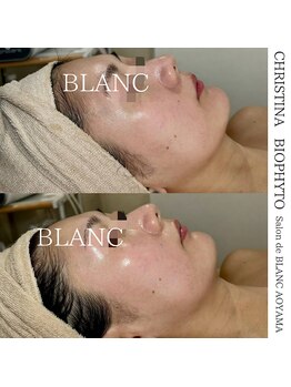 サロン ド ブラン アオヤマ(Salon de BLANC AOYAMA)/BIOPHYTO×韓国美容機器ソノケア