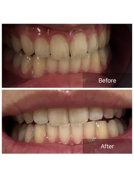 ダンニヒル(dannihil)/【セルフホワイトニング】つるん