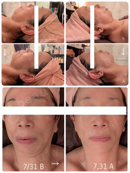 ビューティーサロン ラ ルーチェ(beauty salon La Luce)/大人気☆エニシーグローパック