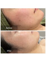 トータルビューティ リライフ(Total beauty Relife)/回数を重ねると変わるお肌