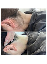 ミース 長野店/うなじ矯正◆ビフォーアフター