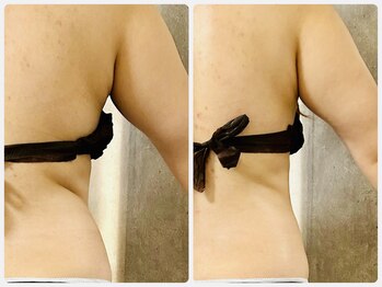 サロン ド キキ(Salon de kiki)/ラジオ波での1回の効果