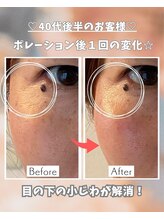 エステサロン 凛/目じりの小じわがっっっ！！！