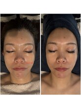 にっこりビューティー/★EMSマッサージ＋エアバリ