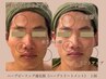 メンズ[毛穴・シワ徹底ケア]本気の肌質改善♪ハーブトリートメント 2g