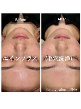 ルナ(LUNA)/エインプラス（毛穴洗浄）