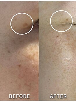 ヒトハダ(hitohada)/40代女性 《シミケア3回》