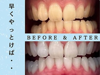 ホワイトニングショップ 浦和店/ホワイトニングビフォーアフター