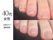 フットケア クラッシー(footcare classy)/こぉんな亀裂が入ったお悩みも！