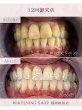 ホワイトニングショップ 福岡姪浜店/美白ホワイトニングbefore after