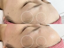 キヌ(KINU)/症例写真（産毛脱毛）