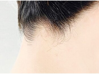 アール(R)/襟足脱毛