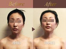 オーシャン(Ocean)/小顔整顔60分/週1回×10回
