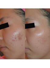 ホワイトアクア 姫路店(WHITE AQUA)/ララピール/姫路/美肌